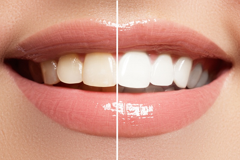 Jak vybělit umělé zuby?